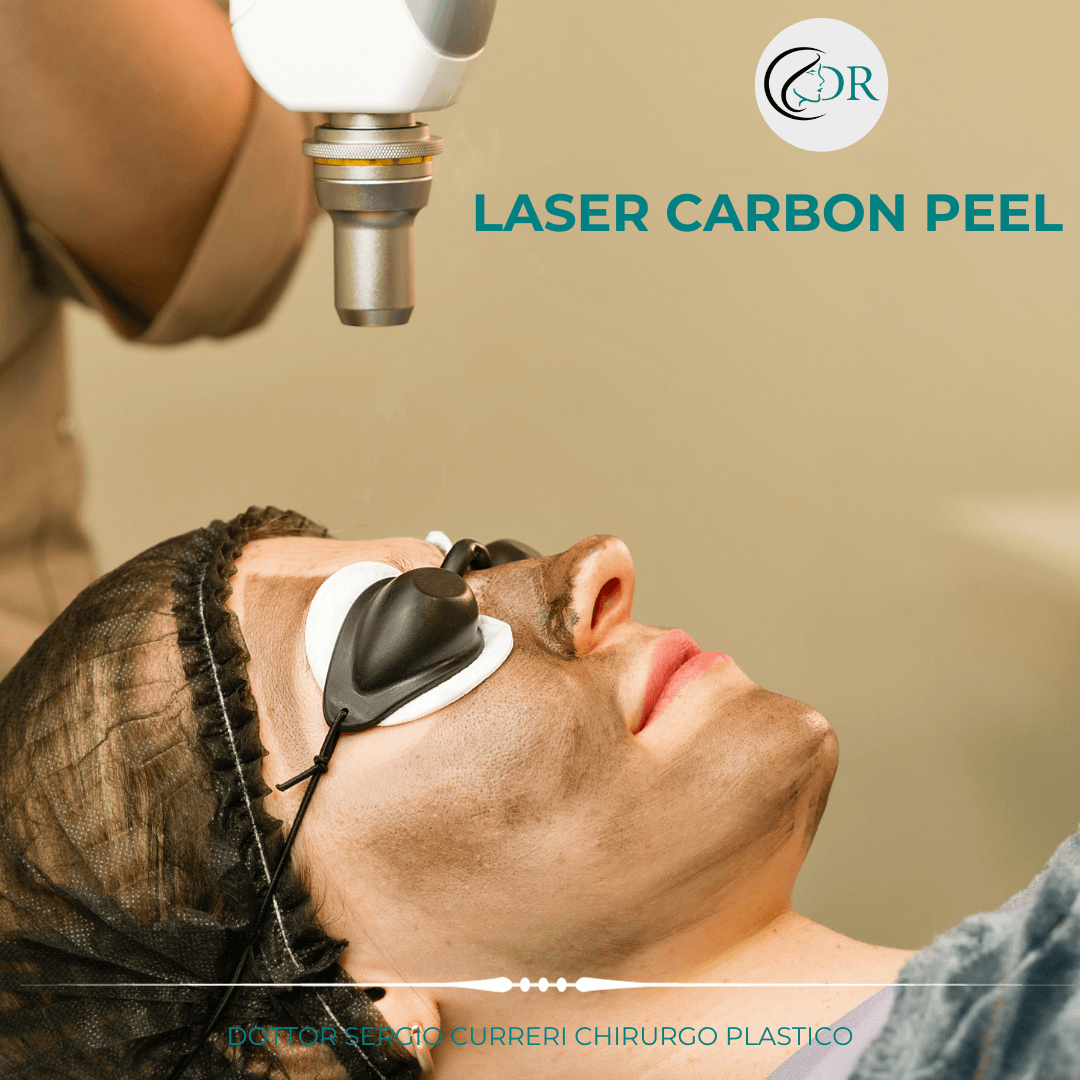 Laser carbon peel LASER CARBON PEEL: PERCHE’ PROVARLO